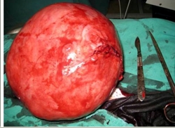 Mulher com tumor de 5 quilos ficou sem atendimento por um ano em Divinópolis tumor 2